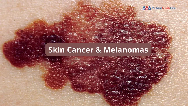 Skin Cancer and Melanomas in Australia